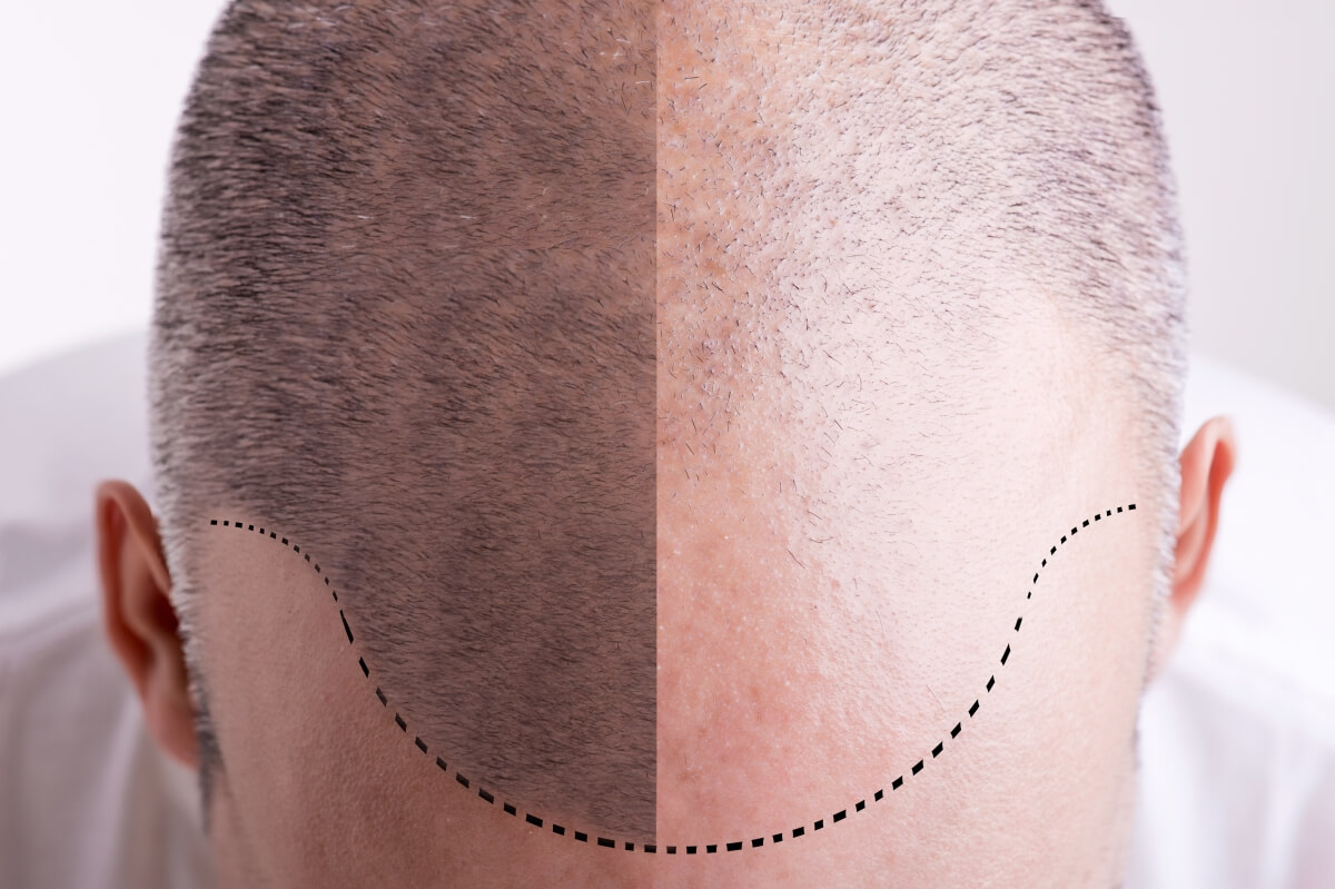 hair transplant orange county Orange County Hair Restoration offers expert hair restoration services to help you achieve a fuller, natural-looking head of hair.