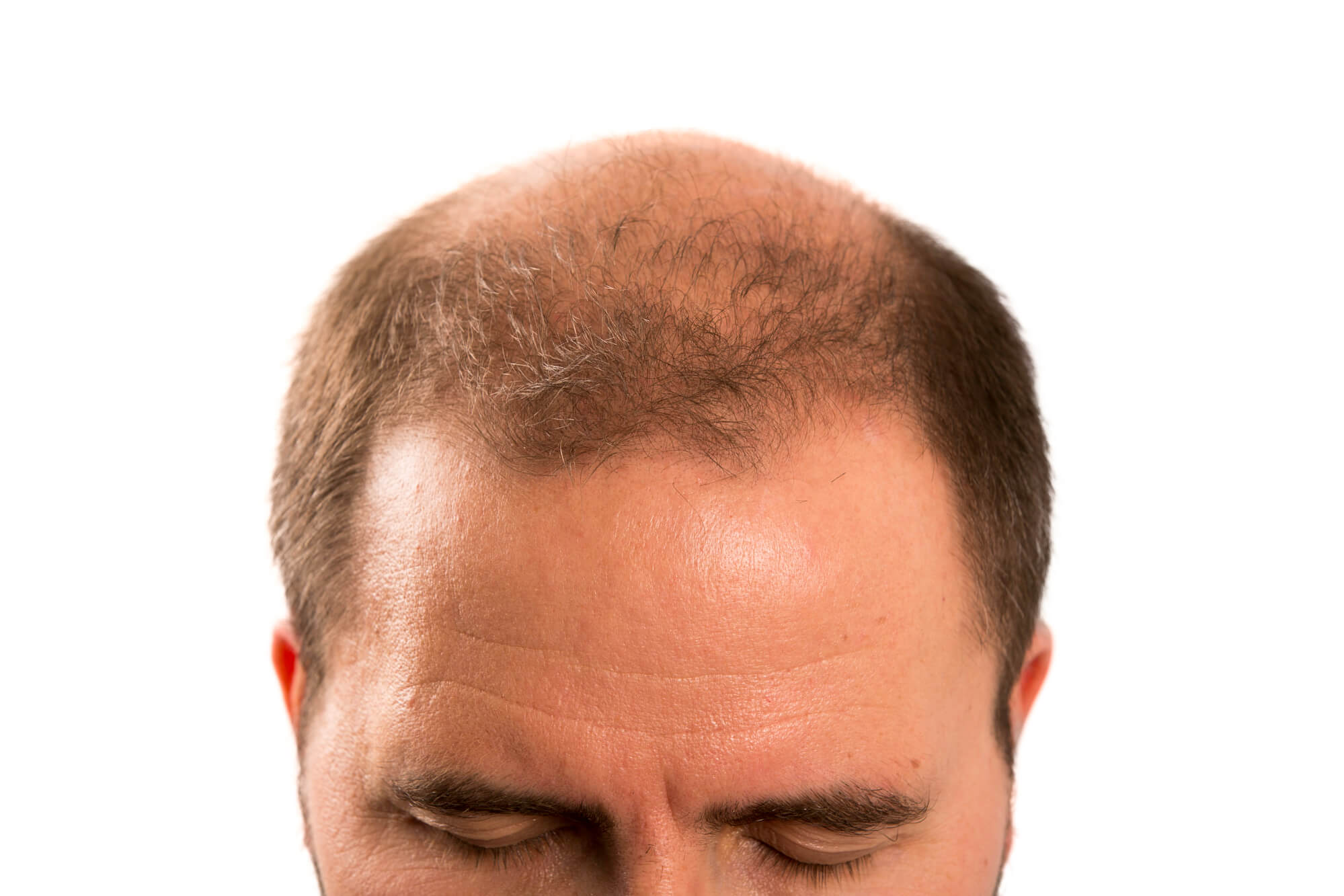 thinning hair treatment Newport Beach Newport Beach Thinning Hair Treatment provides effective solutions to combat hair loss, helping you restore volume and confidence with personalized care.