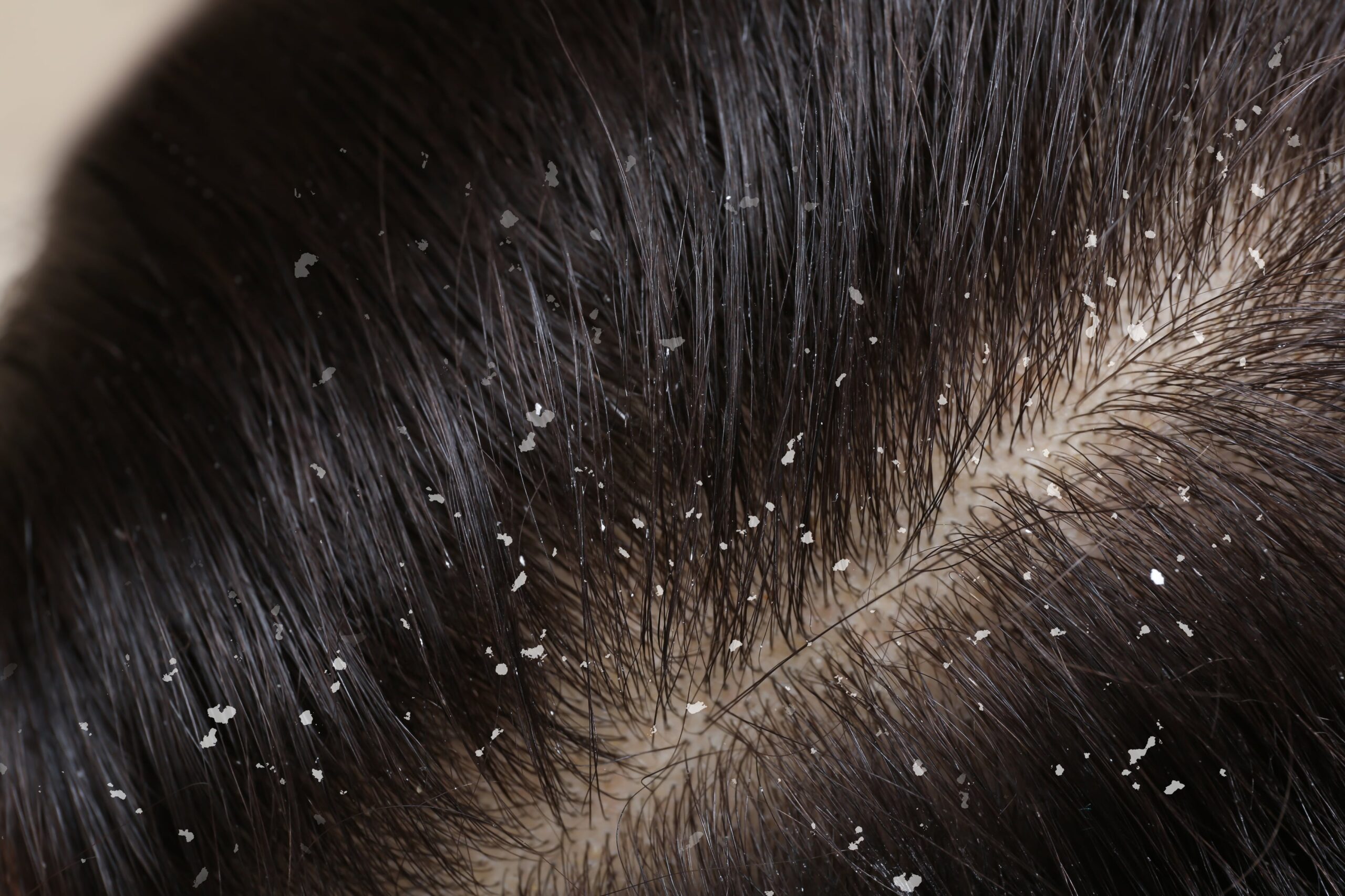 Can dandruff cause hair loss - neograft hair restoration orange county