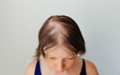 How to Stop Alopecia Areata From Spreading