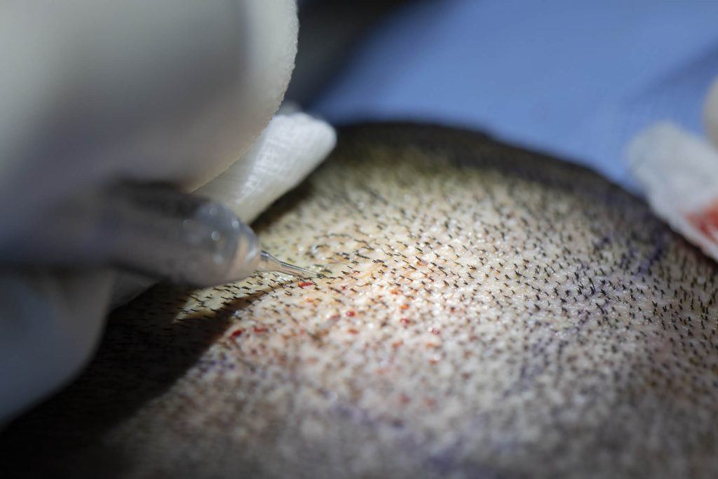 Skilled surgeon conducting FUE hair transplant at Neograft Hair Restoration Orange County California clinic