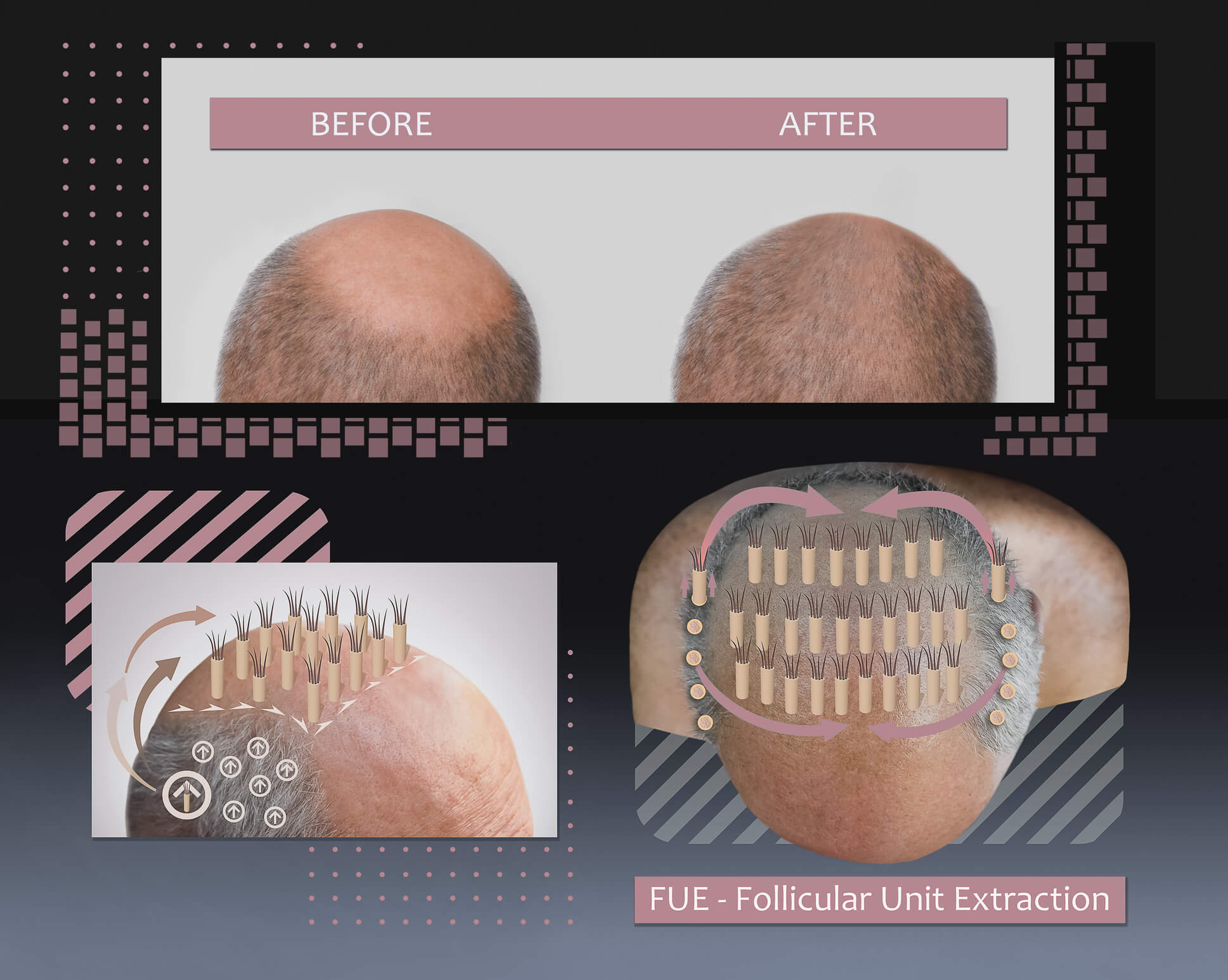 Follicular Unit Extractions Orange County