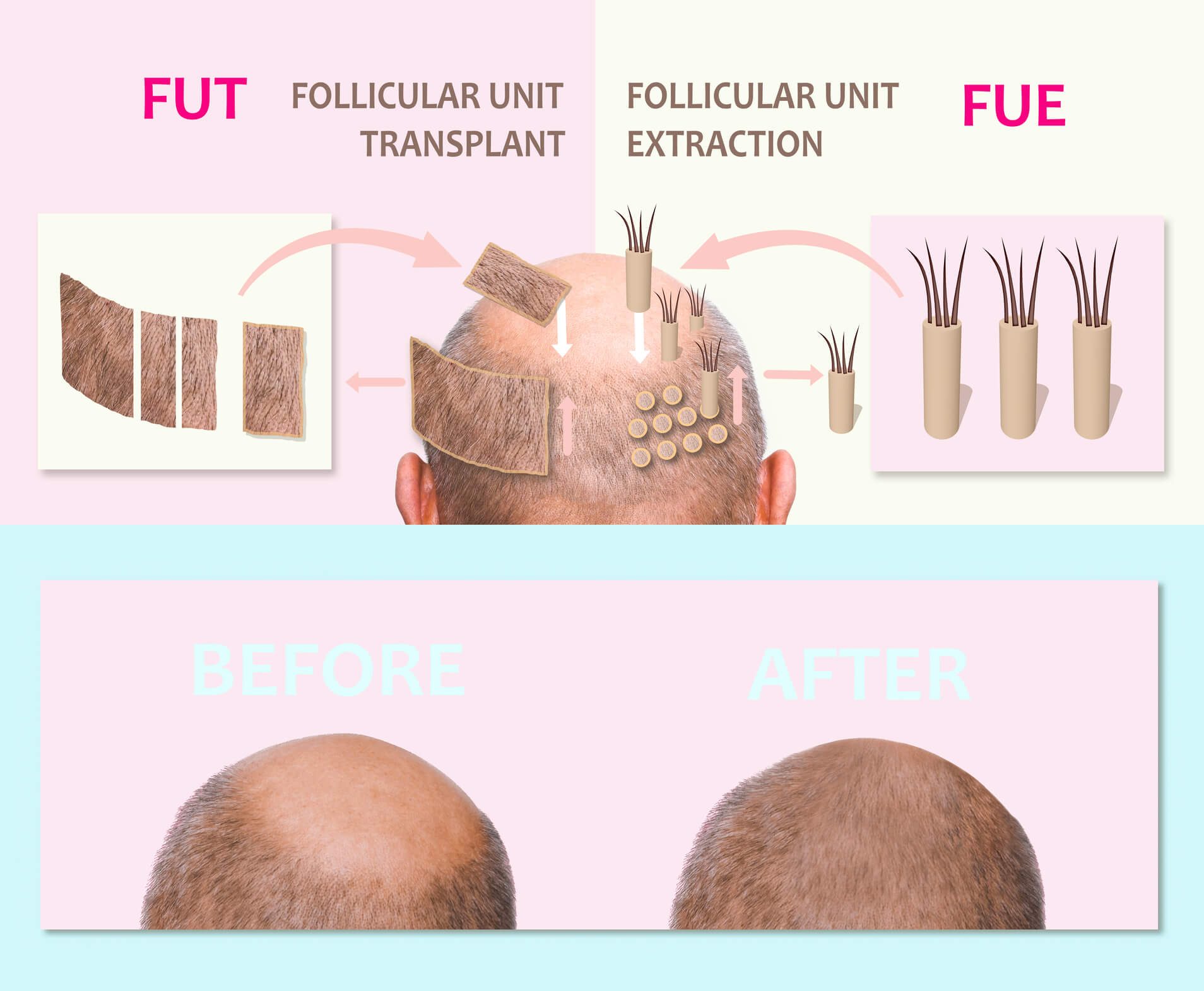 Follicular Unit Transplantation Orange County