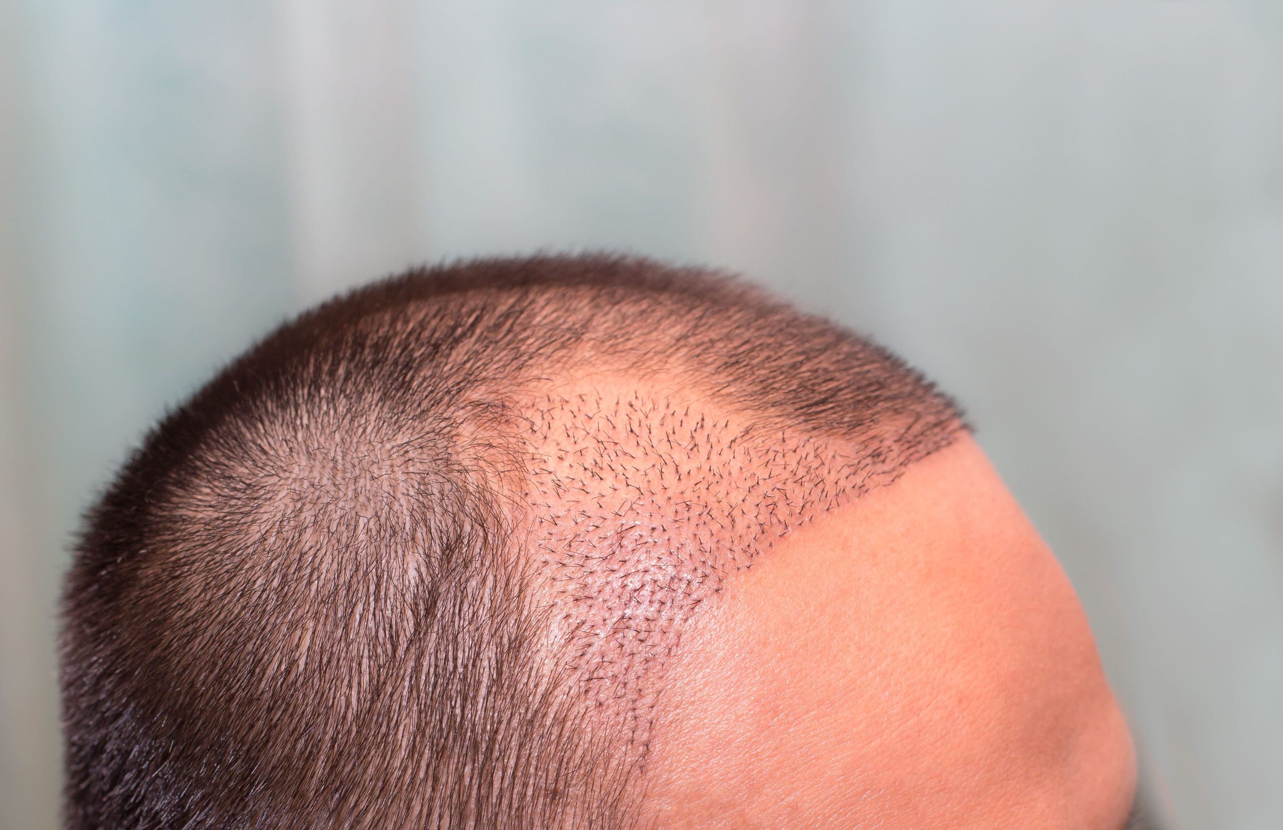 Hair Transplant Archives - Neograft Hair Restoration Orange County