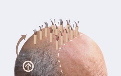 What is a Neograft Hair Transplant?