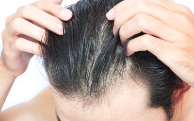Hair Transplant Aftercare