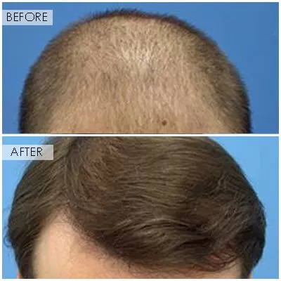 Newport Beach Hair Restoration