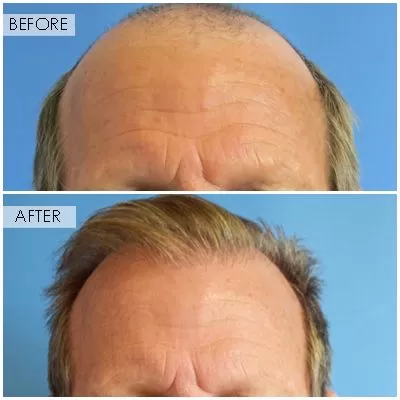 NeoGraft Hair Restoration in Newport Beach, CA