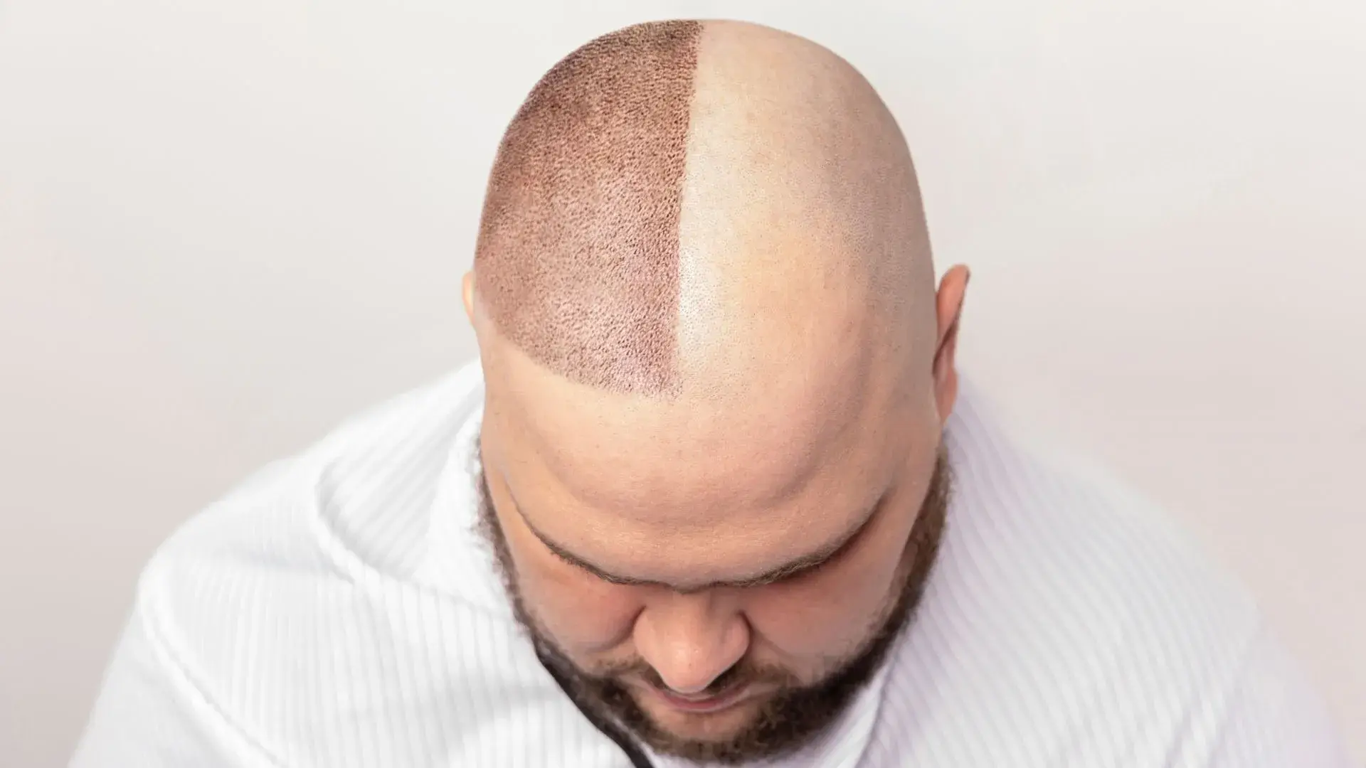 Hair-Restoration-Huntington-Beach-CA Hair Restoration in Huntington Beach, CA
