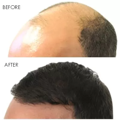 Hair Restoration Orange County