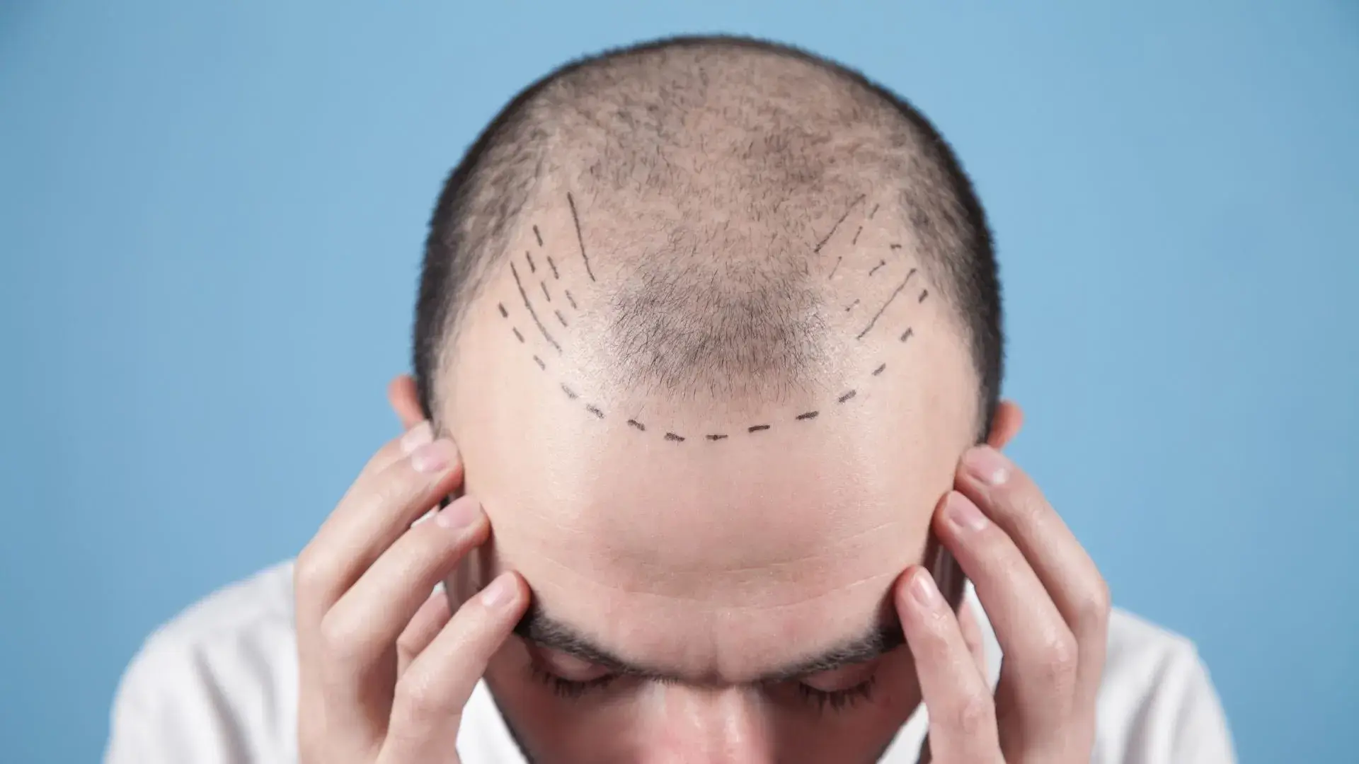 Hair Restoration in Tustin, CA