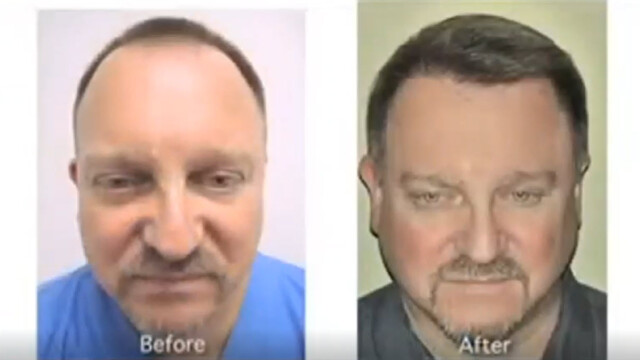 Side-by-side photos of a man labeled "Before" and "After," showing a visible difference in hair density and color on his scalp and beard. Side-by-side photos of a man labeled "Before" and "After," showing a visible difference in hair density and color on his scalp and beard.