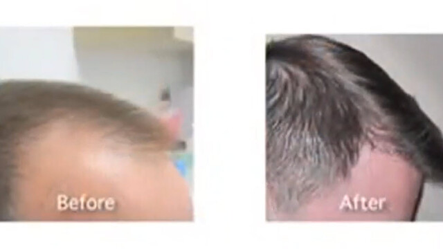 Side-by-side photos show a person's scalp before with thinning hair, and after with noticeably fuller, thicker hair. "Before" and "After" labels are present. Side-by-side photos show a person's scalp before with thinning hair, and after with noticeably fuller, thicker hair. "Before" and "After" labels are present.