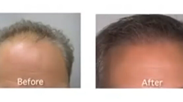 Side-by-side comparison showing a person's forehead and hair before and after treatment; the "before" image shows thinning hair, while the "after" image shows fuller hair. Side-by-side comparison showing a person's forehead and hair before and after treatment; the "before" image shows thinning hair, while the "after" image shows fuller hair.