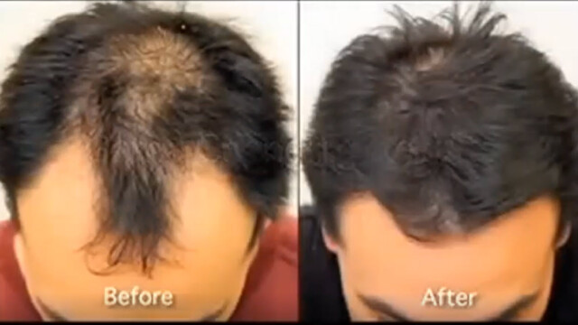 Side-by-side comparison of a man's scalp, labeled "Before" with thinning hair and "After" with visibly fuller hair. Side-by-side comparison of a man's scalp, labeled "Before" with thinning hair and "After" with visibly fuller hair.