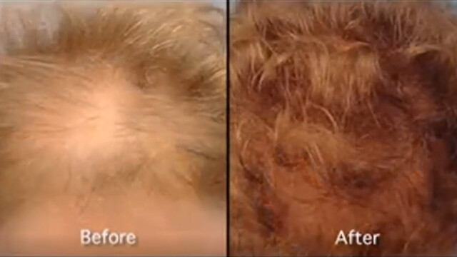 Side-by-side comparison of a scalp showing a bald spot labeled "Before" and the same area with fuller hair labeled "After. Side-by-side comparison of a scalp showing a bald spot labeled "Before" and the same area with fuller hair labeled "After.
