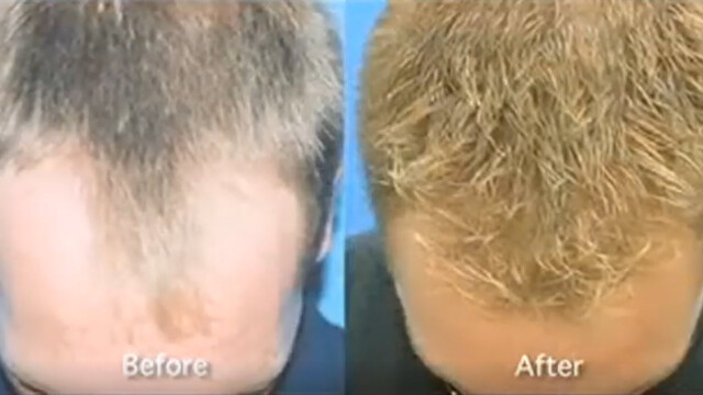 Side-by-side comparison of the top of a person's head showing thinner hair labeled "Before" and fuller hair labeled "After. Side-by-side comparison of the top of a person's head showing thinner hair labeled "Before" and fuller hair labeled "After.
