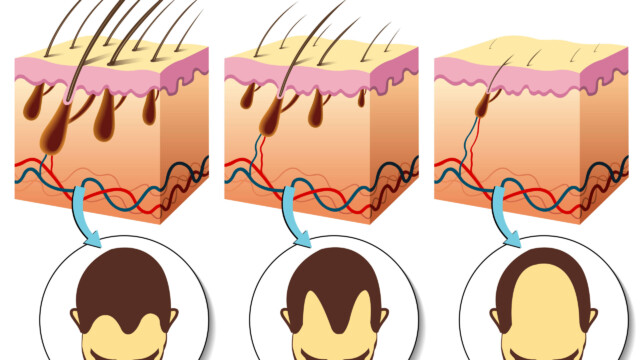 Hair loss Hair loss
