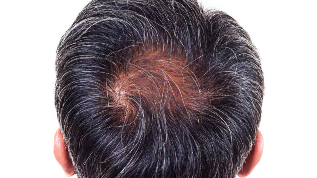 thinning hair treatment Orange County thinning hair treatment Orange County