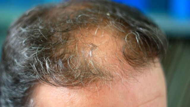 treatment for receding hairline Orange County treatment for receding hairline Orange County